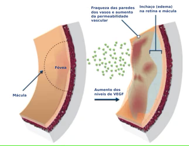 Edema Macular Diabético (EMD) Edema Macular Diabético (EMD)